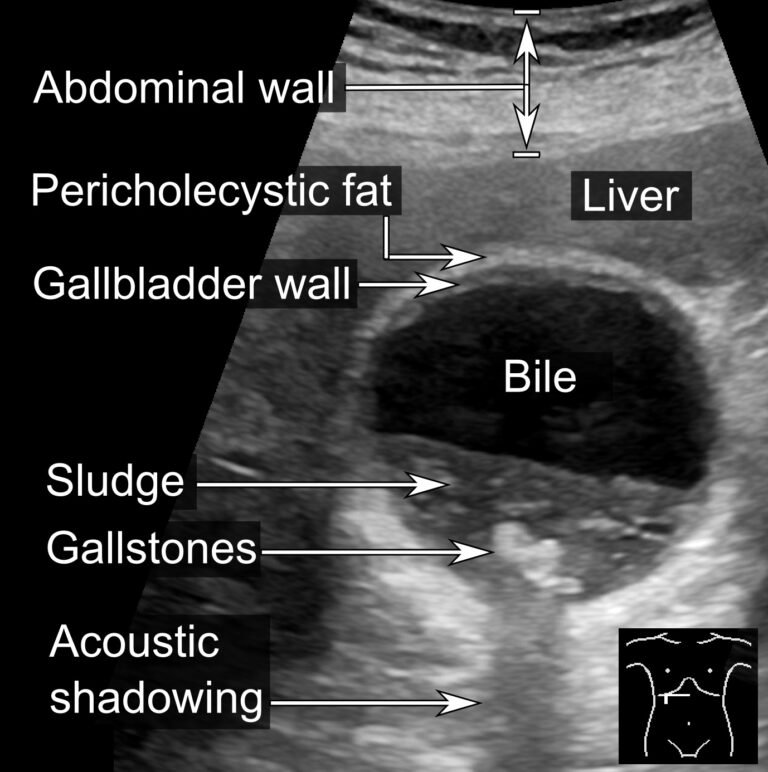 gallbladder-sludge-gallstone-clinic