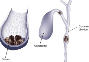 How-to-prevent-gallstone