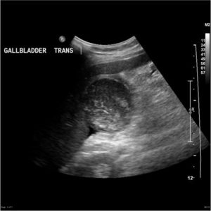 Gangrenous Gallbladder Ultrasound