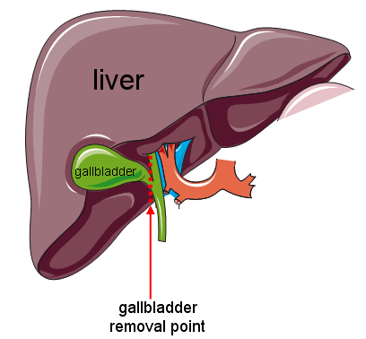 The Gallbladder: An Illustrative Overview - Gallstone Clinic