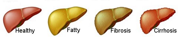 What Are Fatty Deposits In The Liver?