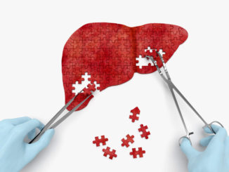 Liver flukes and liver stones