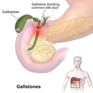 Gallbladder Pain Location in Females Image