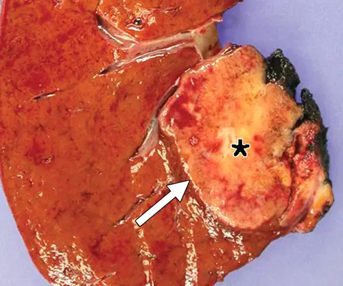 Cholangiocarcinoma or bile duct cancer