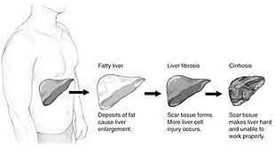 Different Stages of Fatty Liver