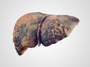 Get To Know About Echogenic Liver Symptoms