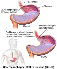 GERD (Gastroesophageal reflux disease)
