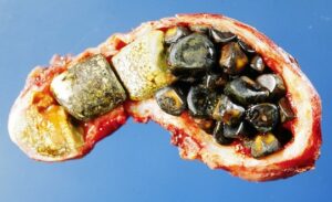 What are gallstones?